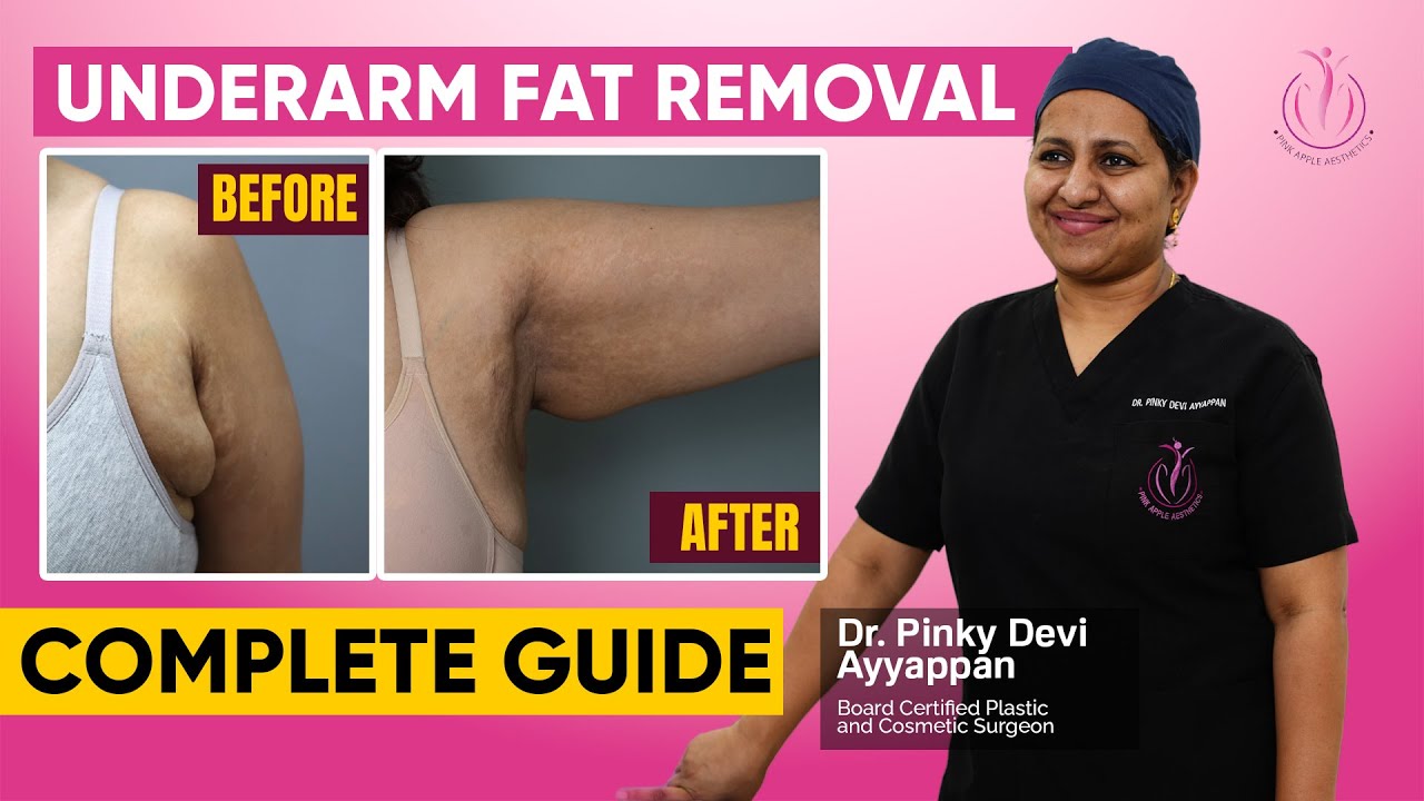 Axillary Breast or Accessory Breast Tissue: Effective Treatments & Quick Recovery Tips!