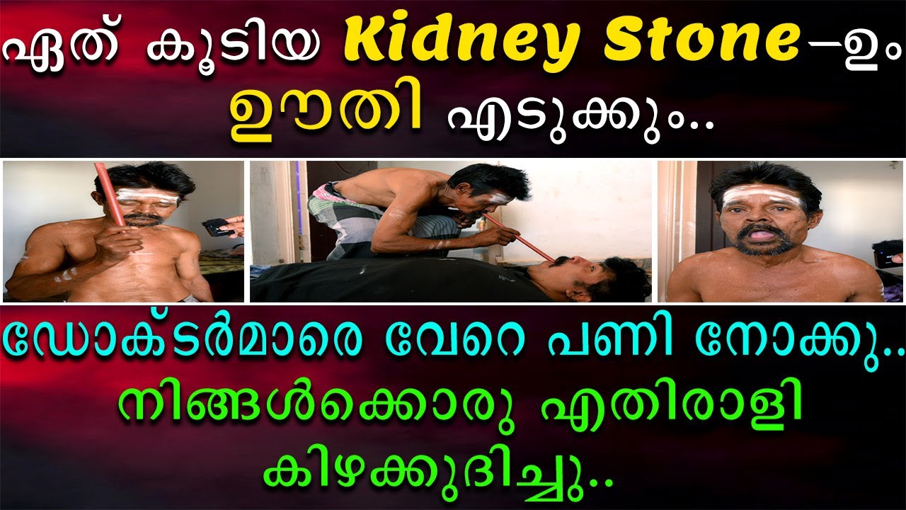 ഏത് കൂടിയ കിഡ്നി സ്റ്റോണും ഊതി എടുക്കും | ഡോക്ടർമാരെ വേറെ പണി നോക്കു