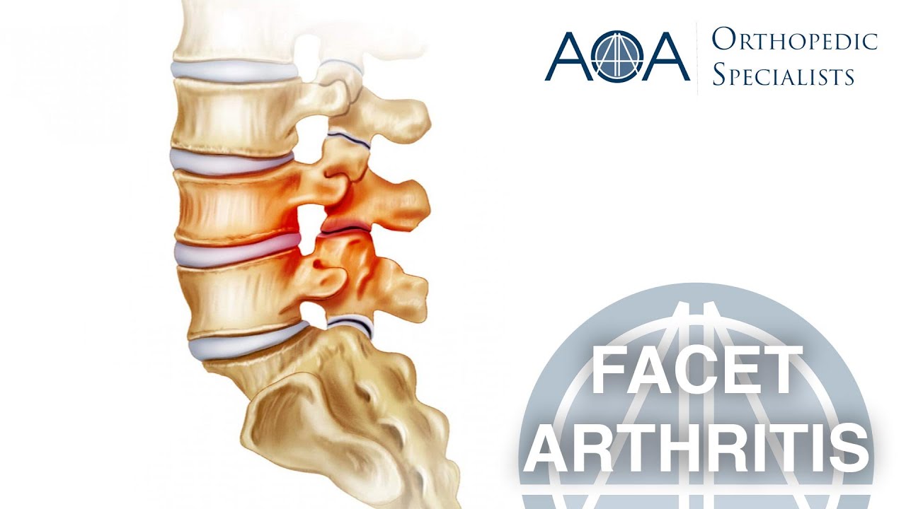 AOA Orthopedic Specialists - Facet Arthritis