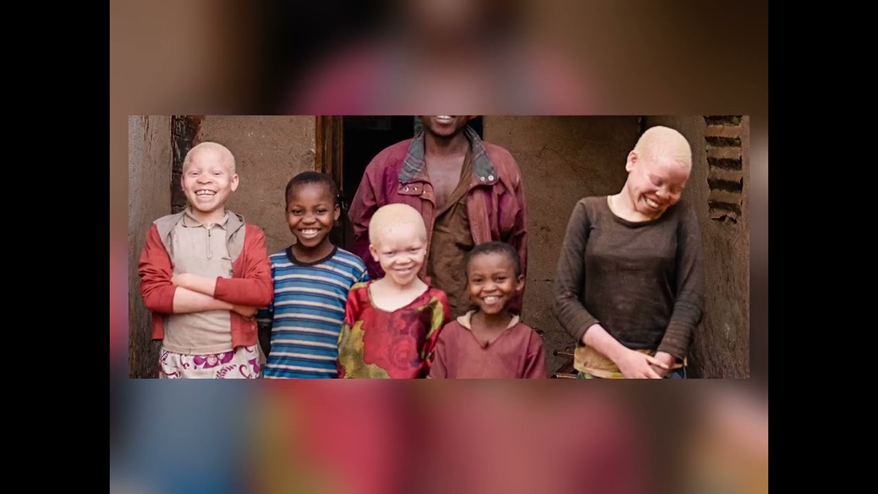 Understanding Albinism: Causes, Risks, and Protective Measures