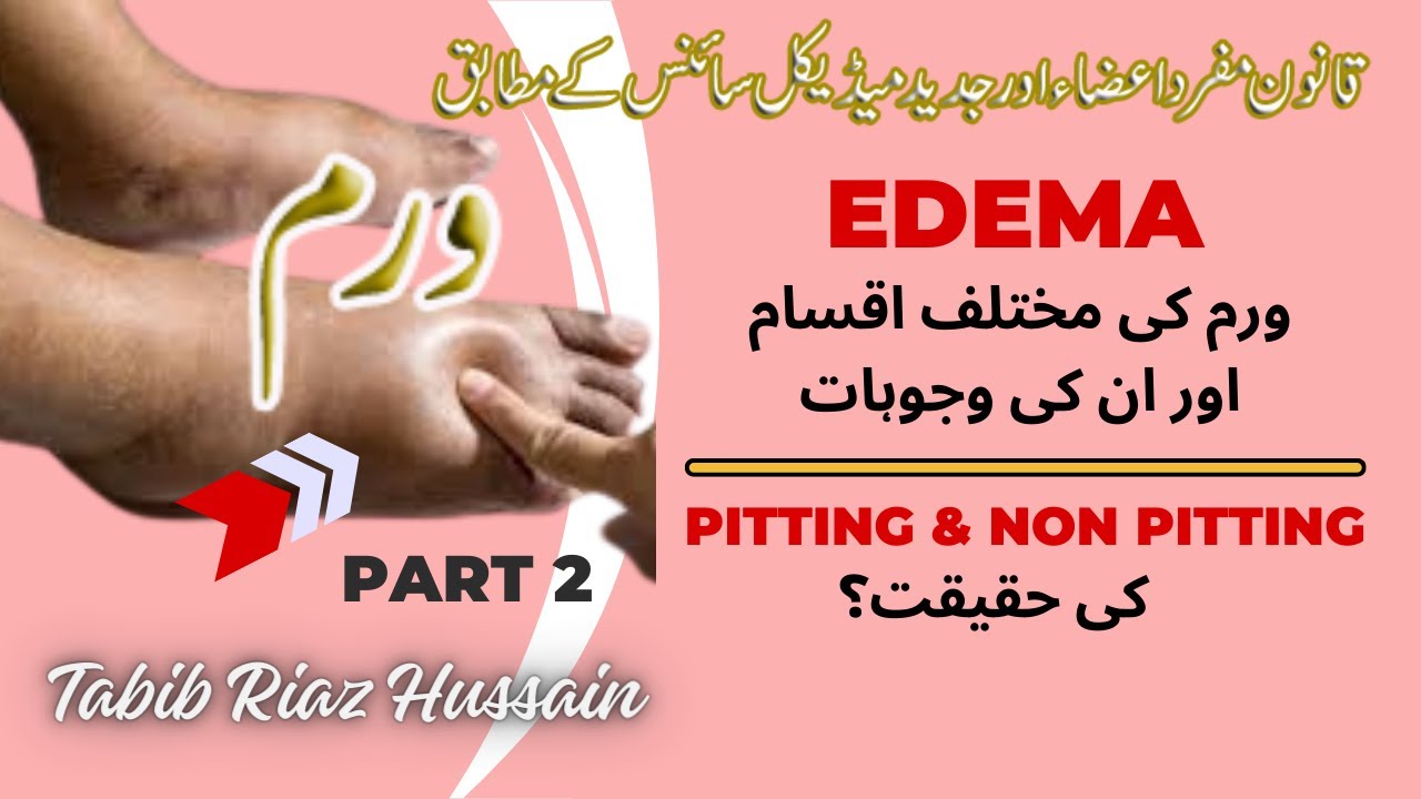 Edema lecture in Urdu Hindi P2 | Types of Edema | Generalized Edema | Pitting & non pitting edema