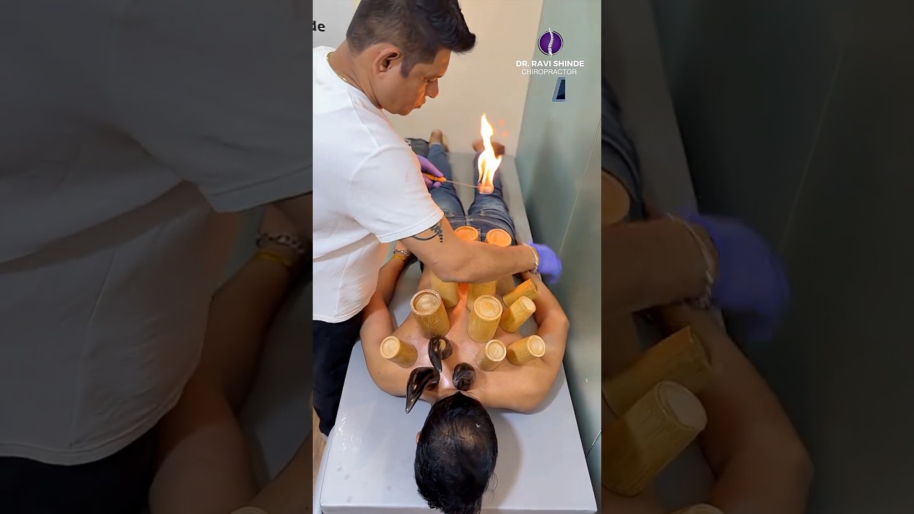 FAST Ankylosing Spondylitis Relief: Fire Cupping + Chiropractic + Acupuncture Combo! 