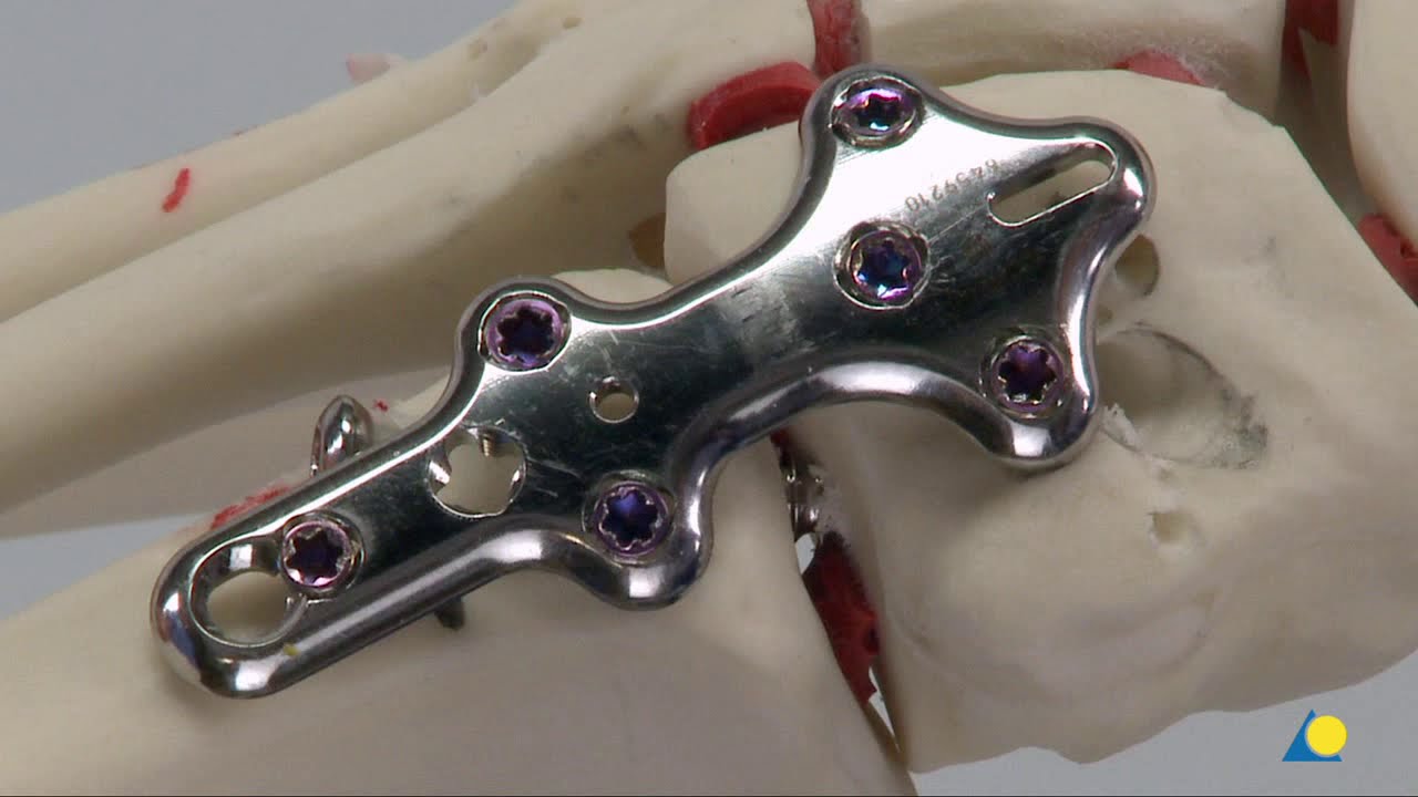 Midfoot - Lisfranc Injury (TMT Fracture or Dislocation) - Using Cortex Screws & 1st TMT Fusion Plate