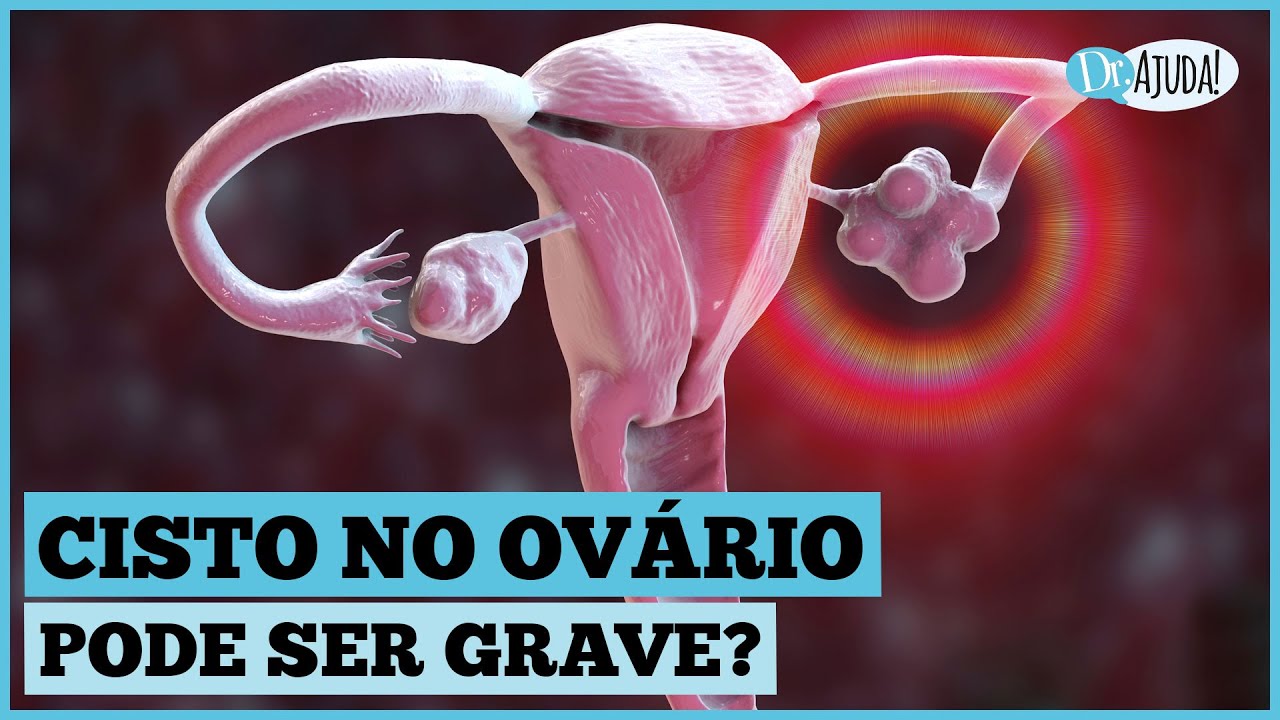 QUANDO SE PREOCUPAR COM CISTO DE OV&Aacute;RIO?