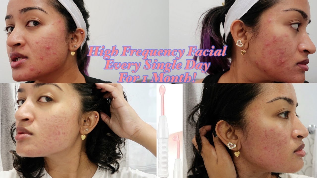 High Frequency Facial Before and After results For Acne Skin 1 Month Update