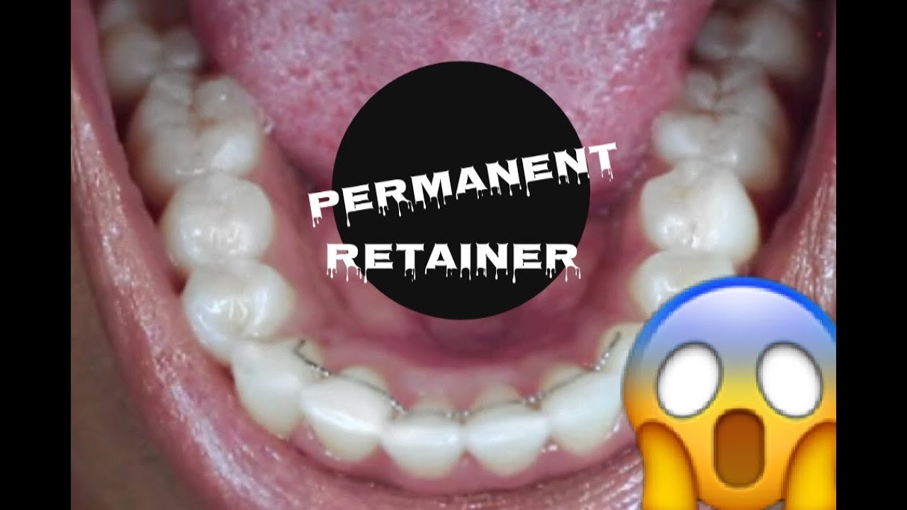 HOW TO CLEAN A PERMANENT RETAINER AFTER BRACES!!