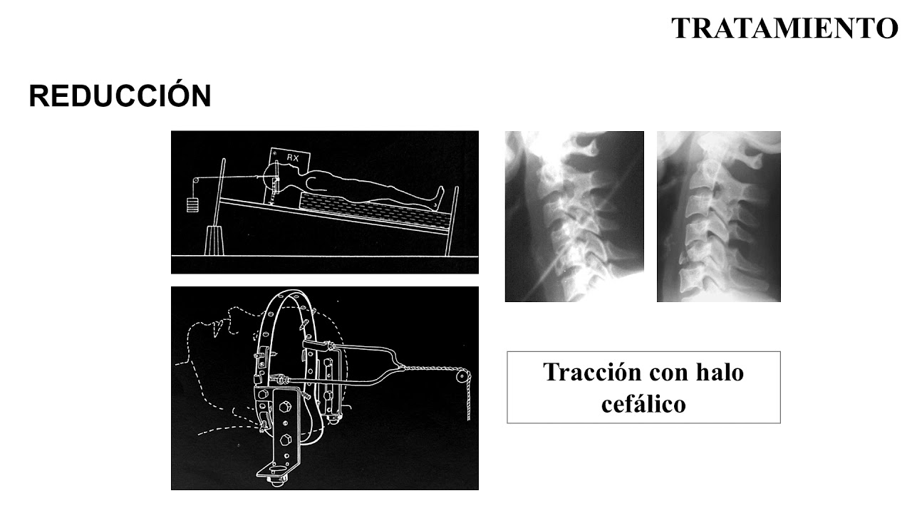 Trauma Raquimedular IV