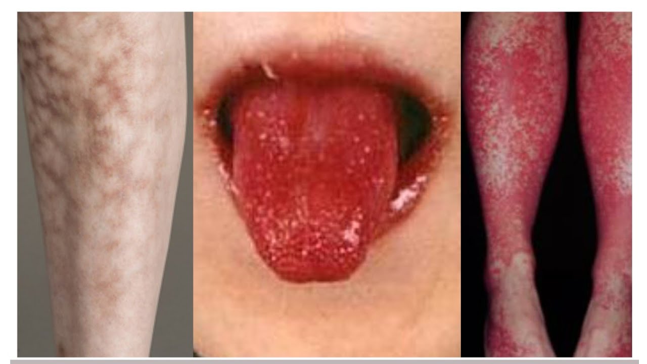 Vasculitis || Dr (Col) Vishal Marwaha|| AIMS,Kochi