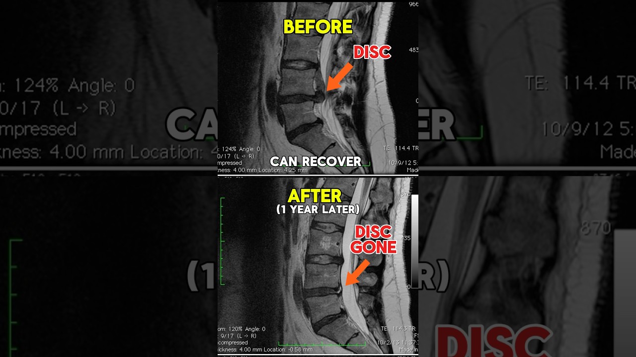 Real Life Example: Low Back Disc Herniation Can Heal