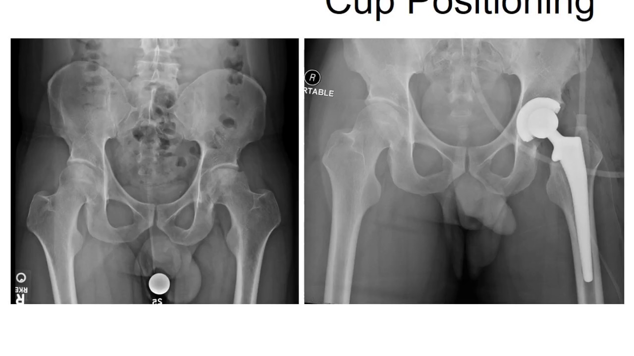 Cup Positioning and Anatomic Restoration: Using Fluoroscopy in the Direct Anterior Approach