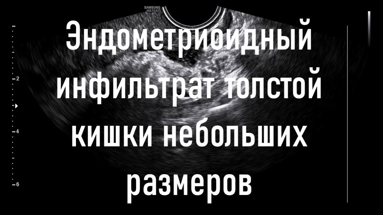 Эндометриоидный инфильтрат толстой кишки небольших размеров