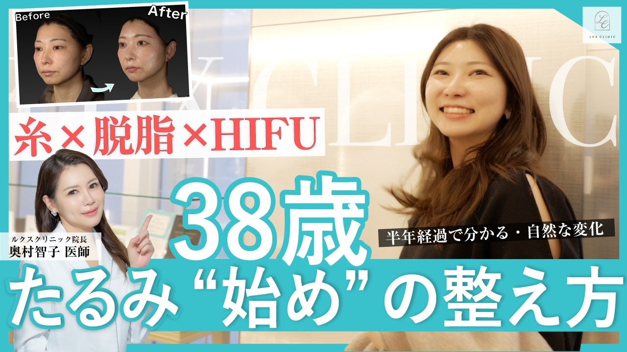 【38歳】「あれ？たるんでる？」不意打ち写真で気づいた変化｜糸リフト・脱脂・HIFU治療の全経過公開（6ヶ月後まで）【奥村智子院長】