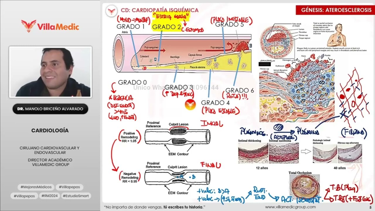 Cardiopatía Isquémica 1/2 VILLAMEDIC