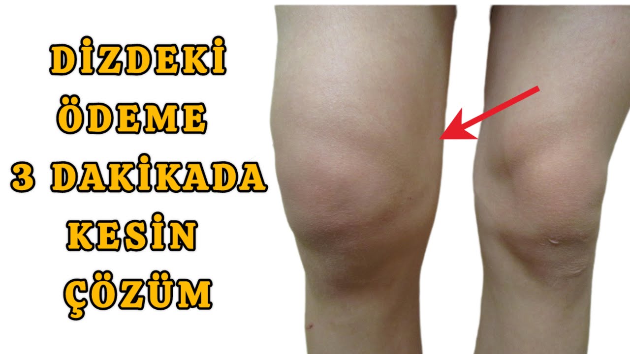 Fizyoterapistten Dizdeki Sıvı Birikmesi Ve Ödemi Bitiren 3 Egzersiz