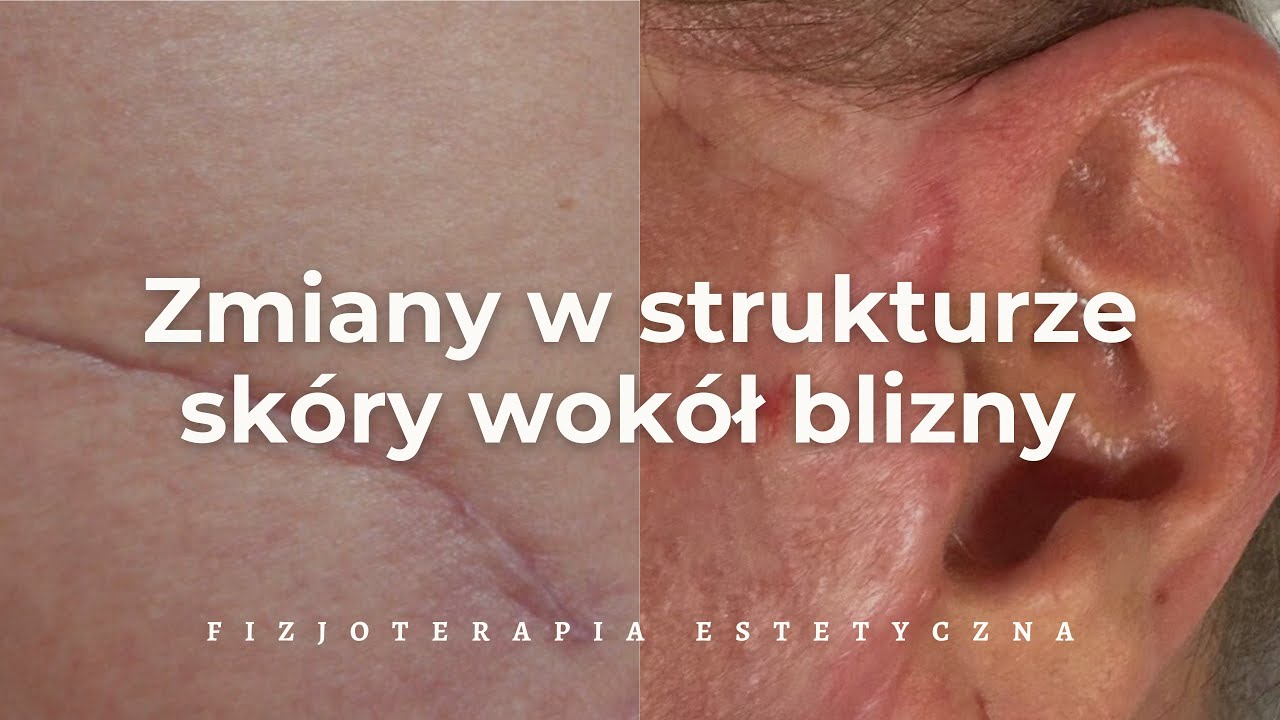 Zmiany w strukturze skóry wokół blizny | Dr n. med. Jacek Szwedo