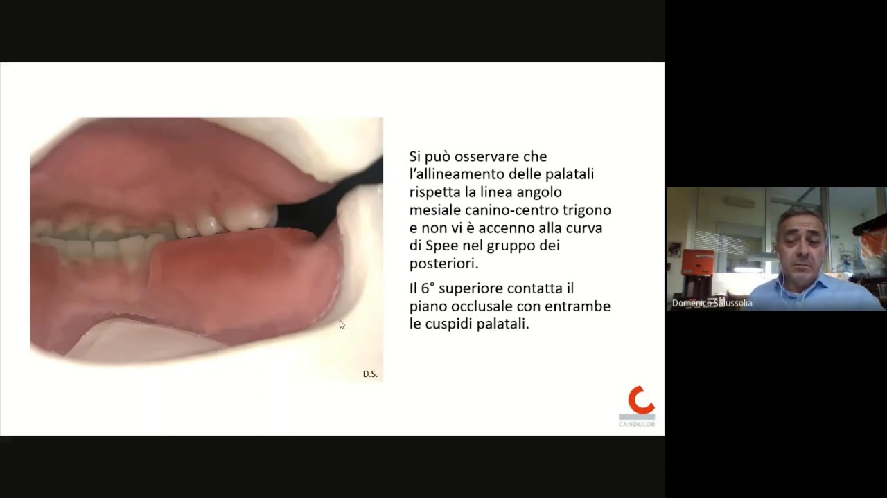 Tecnica di montaggio di PTM secondo Pound