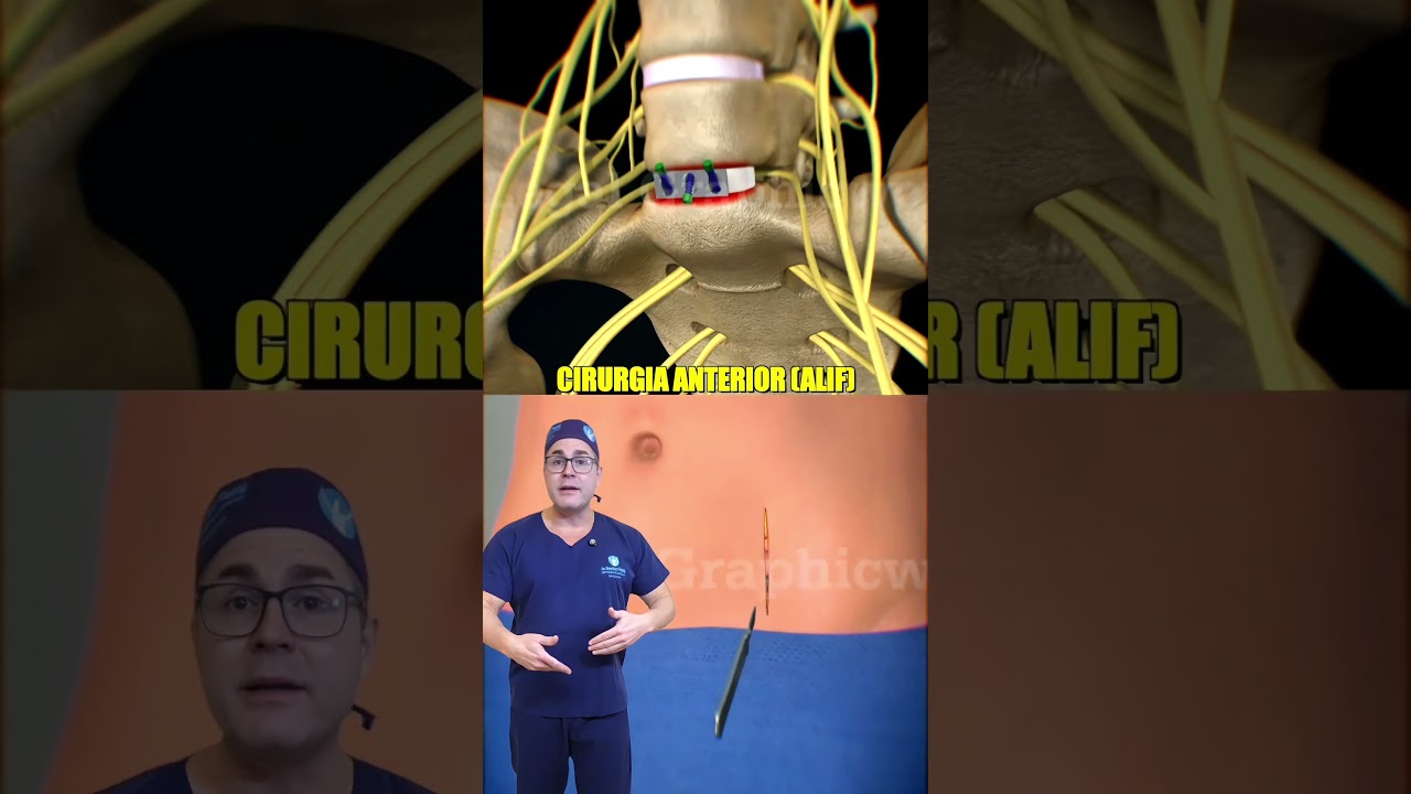 CIRURGIA DE COLUNA LOMBAR MODERNA - ALIF - #listesis #herniadedisco #dorlombar