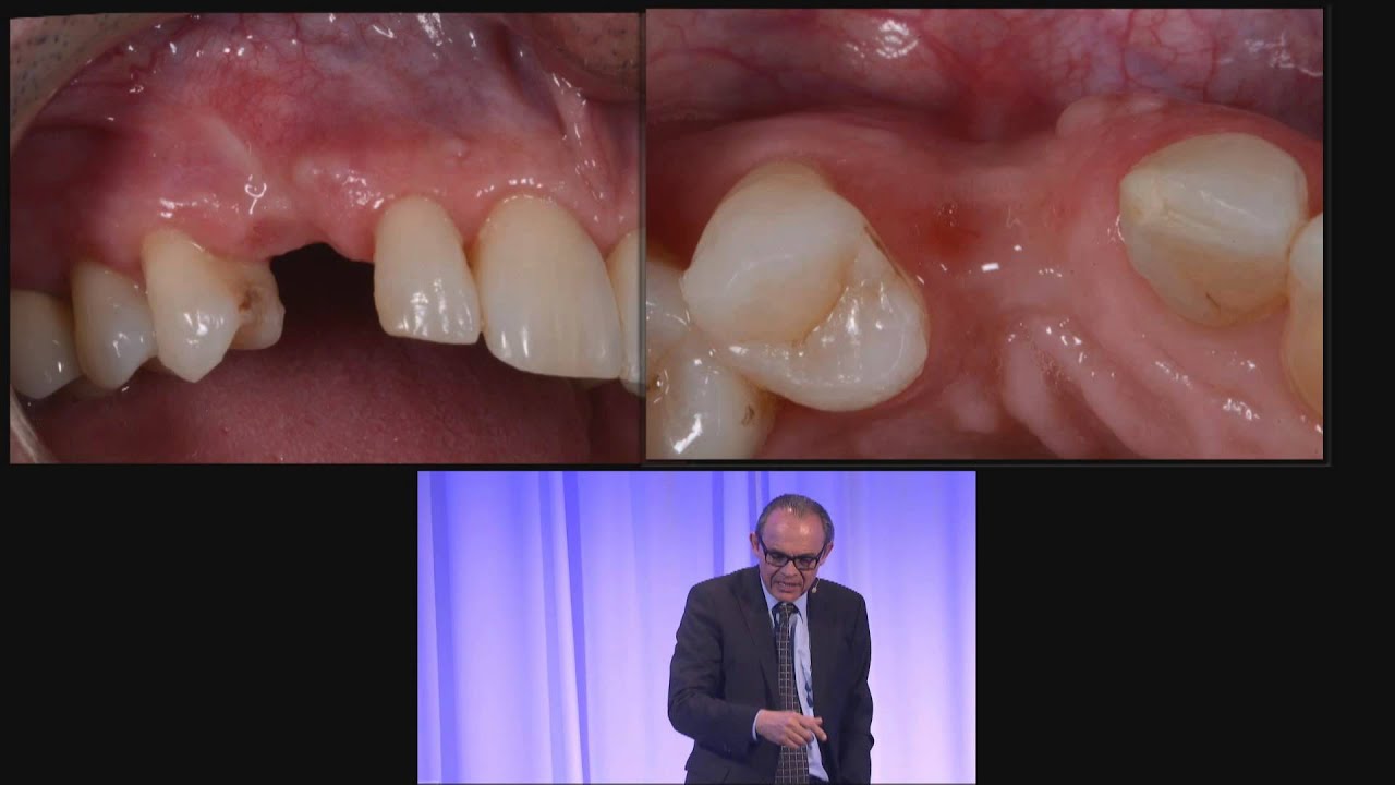 LMT Labday 2014: Integrated treatment workflow, NobelClinician with SmartFusion