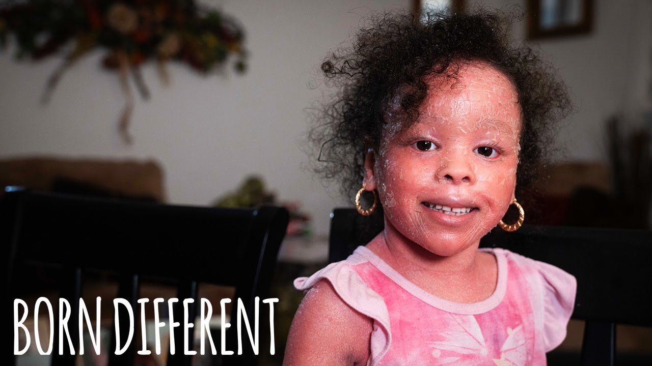 The Little Girl Whose Skin Grows Too Fast | BORN DIFFERENT