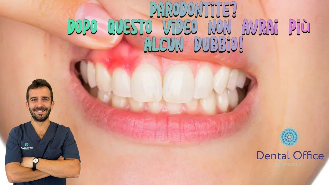 Cos'è la PARODONTITE e come evitare di perdere i tuoi DENTI