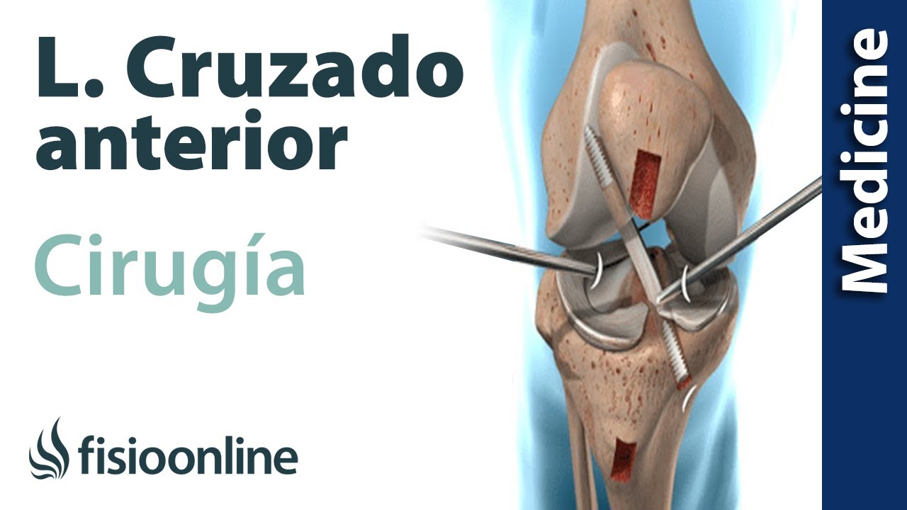 CIRUGÍA del LIGAMENTO CRUZADO ANTERIOR
