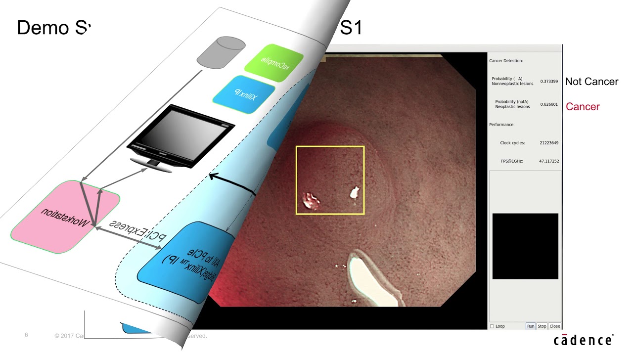 Computer Aided Diagnosis System using Tensilica Vision P6 DSP