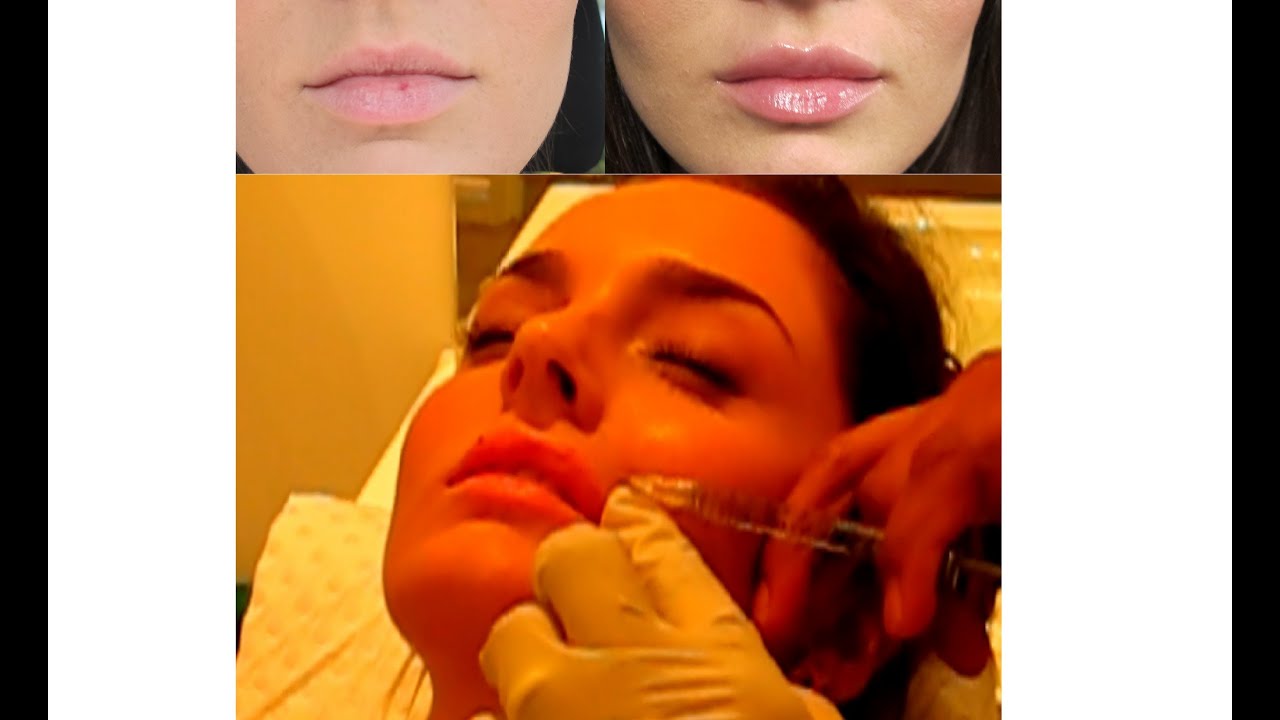 Lip Augmentation VLOG: My Injection Experience