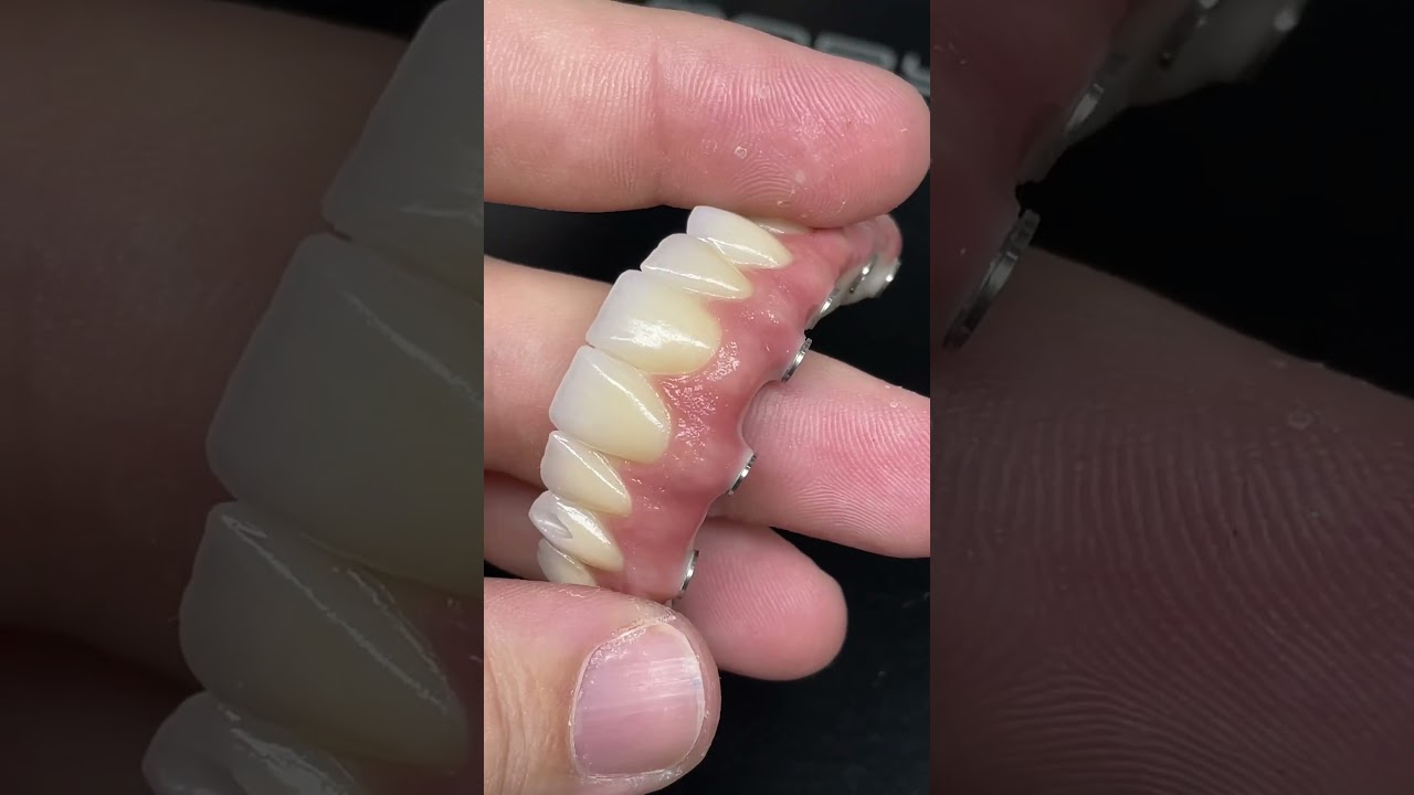 Mais um protocolo Monol&iacute;tico em zirc&ocirc;nia com estratifica&ccedil;&atilde;o de gengiva