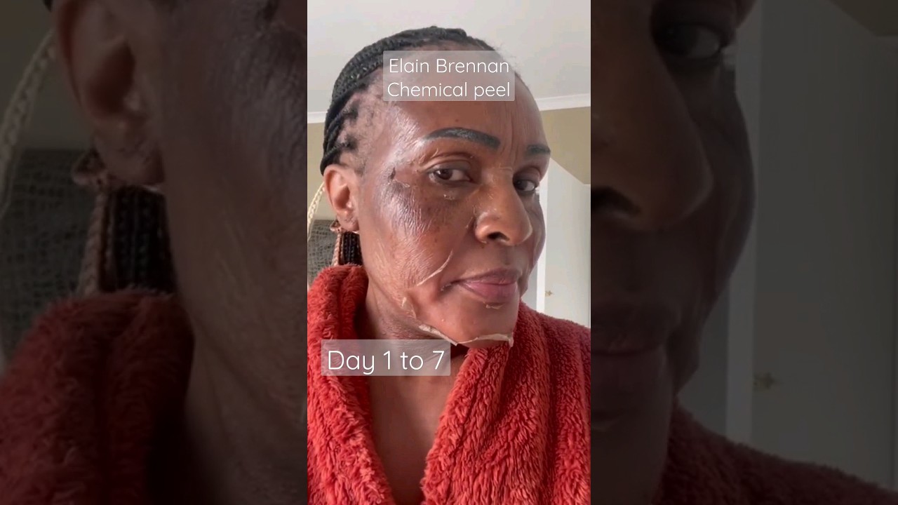 Chemical peel, day 1 to 7 , skin Resurfacing #foryou #shorts #shortvideo