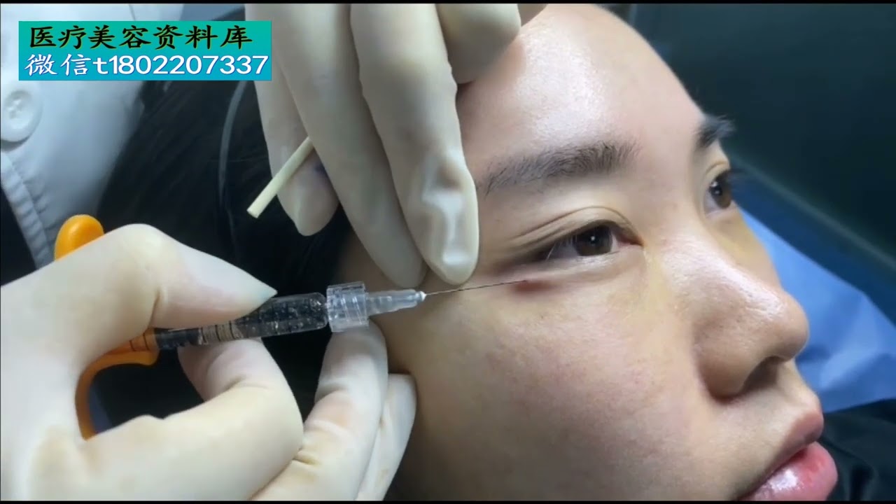 2.玻尿酸注射卧蚕（钝针）| 2. Hyaluronic Acid Injection for Aegyo Sal (Blunt Needle)