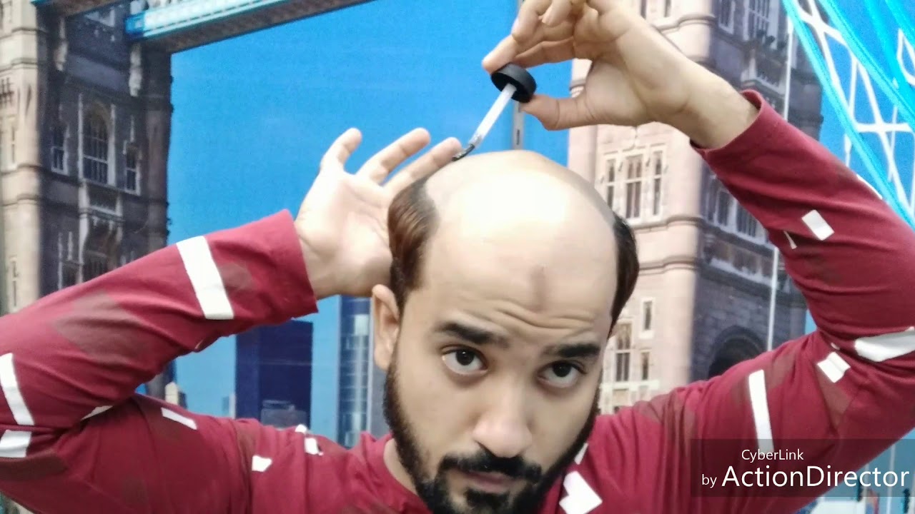Small lenght hair patch system in delhi, 9650914665, W/C free consultant ANAS SHEIKH