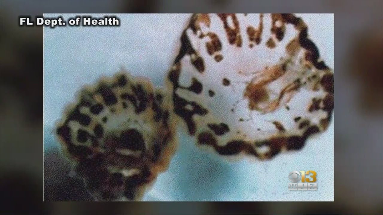 Sea Lice Outbreak Reported In Ocean City