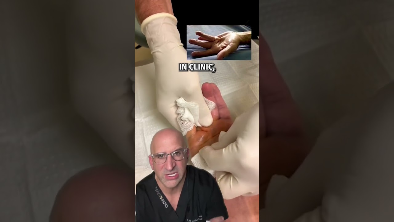 Listen for the POP 🔊DUPUYTREN&rsquo;S Contracture Quick Fix #shorts
