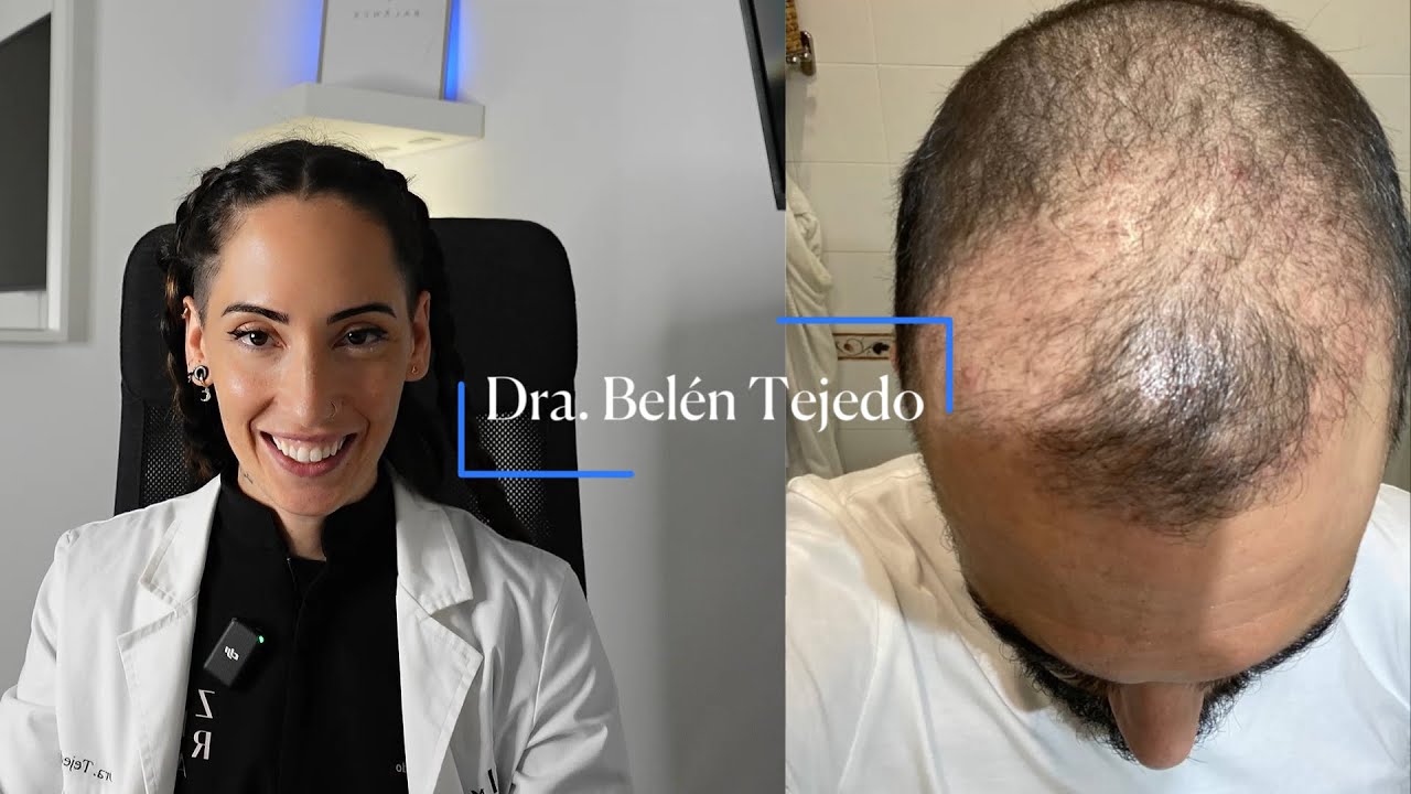 ¡Sorpresa!  Evolución tras injerto capilar: desde el shockloss hasta el resultado final. ✨