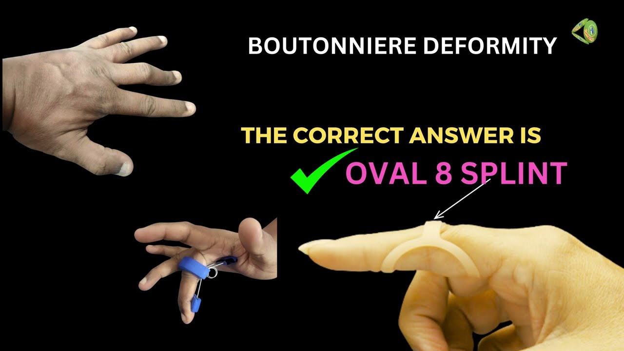 NEET PG  MCQ's - Hand splints, related Orthoses and mnemonics - part two.