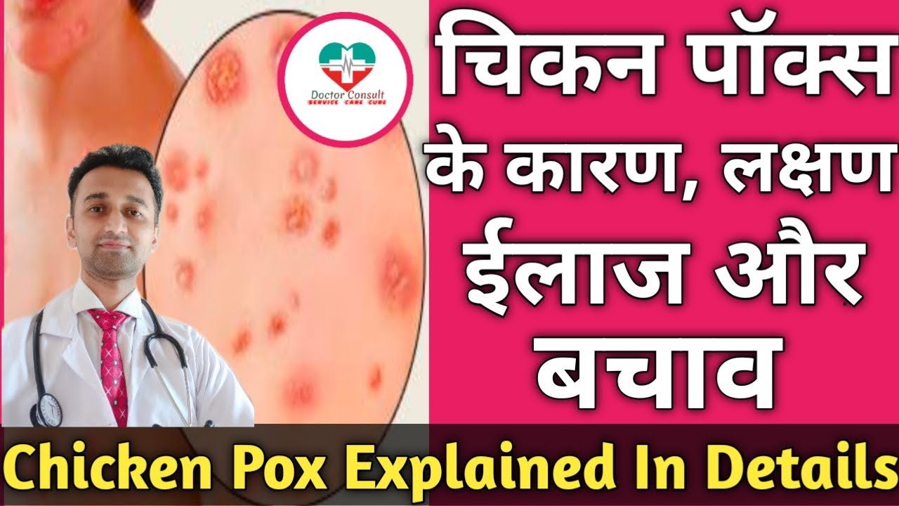 Chicken Pox in hindi! Chicken pox Symptoms ! Dr.K.S.Chougule.