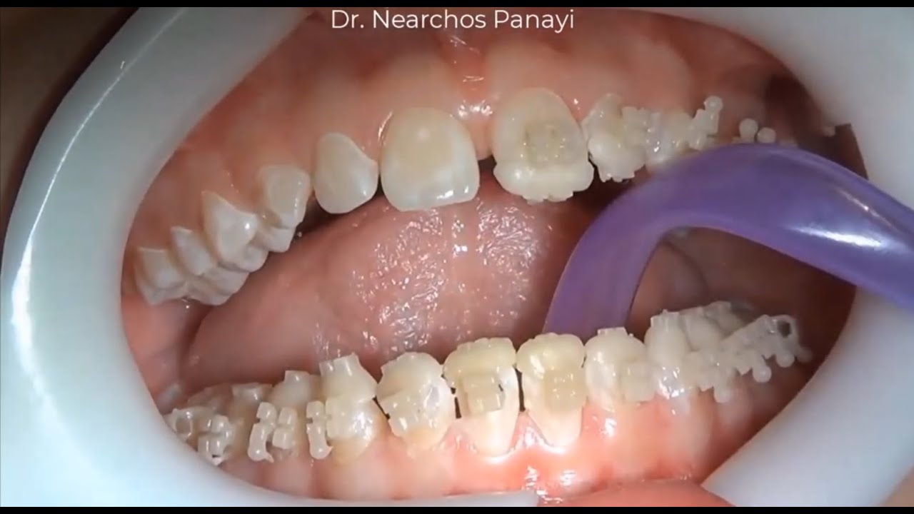 3D printed customised brackets for orthodontics and indirect bonding