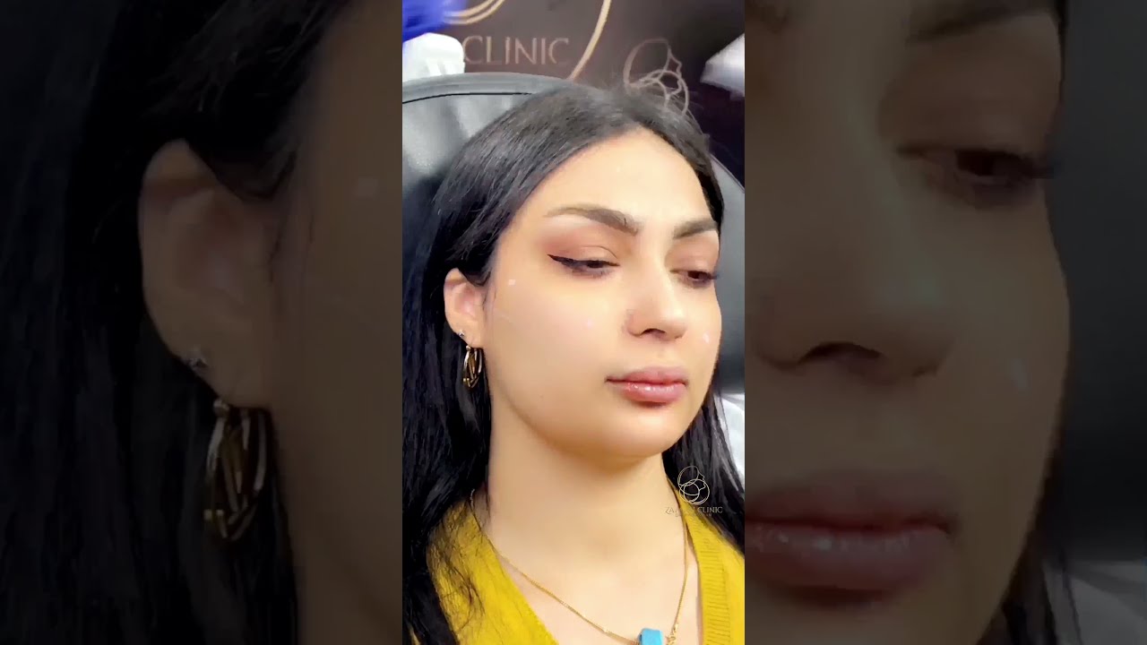 Filler Cheek Augmentation 🤩😉💉                            #short #cheekfiller #shorts #cheeks