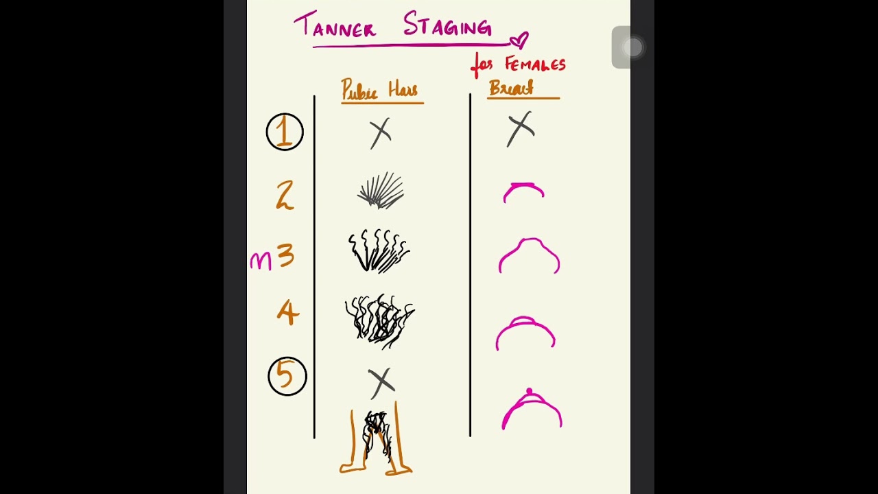 TANNER STAGING (pubarche,telarche )# NEET PG 2021