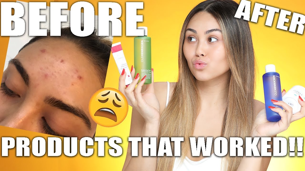 HOW I CLEARED MY ACNE | Roxette Arisa