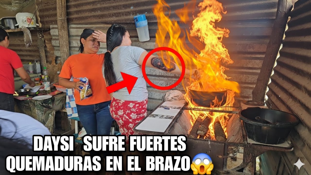 Santo Dios DAYSI Sufre Fuerte Quemadura En El Brazo😱 Si No Lo Grabo  No Lo Creerias 😮 