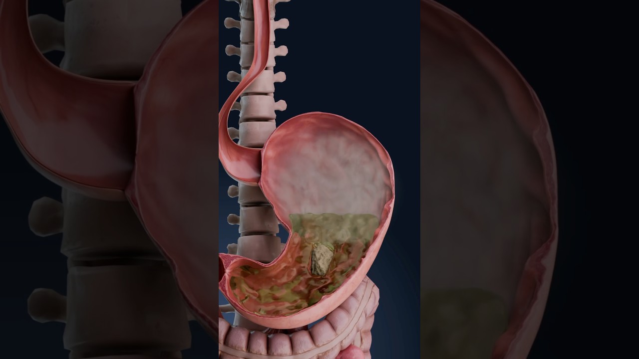 Visualizaci&oacute;n 3D de la distensi&oacute;n abdominal: &iquest;qu&eacute; est&aacute; ocurriendo en tu cuerpo?