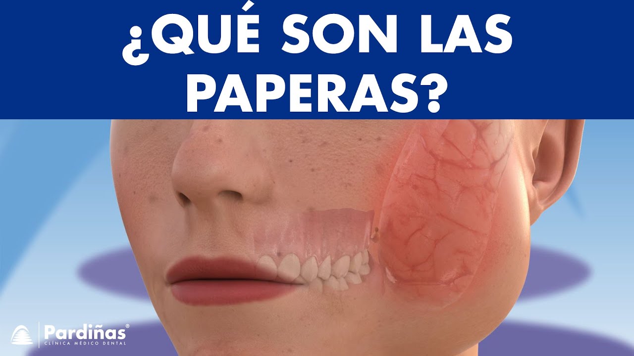 PAPERAS (o parotiditis) y otras afecciones salivales: sialoadenitis, sialolitiasis y mucocele ©