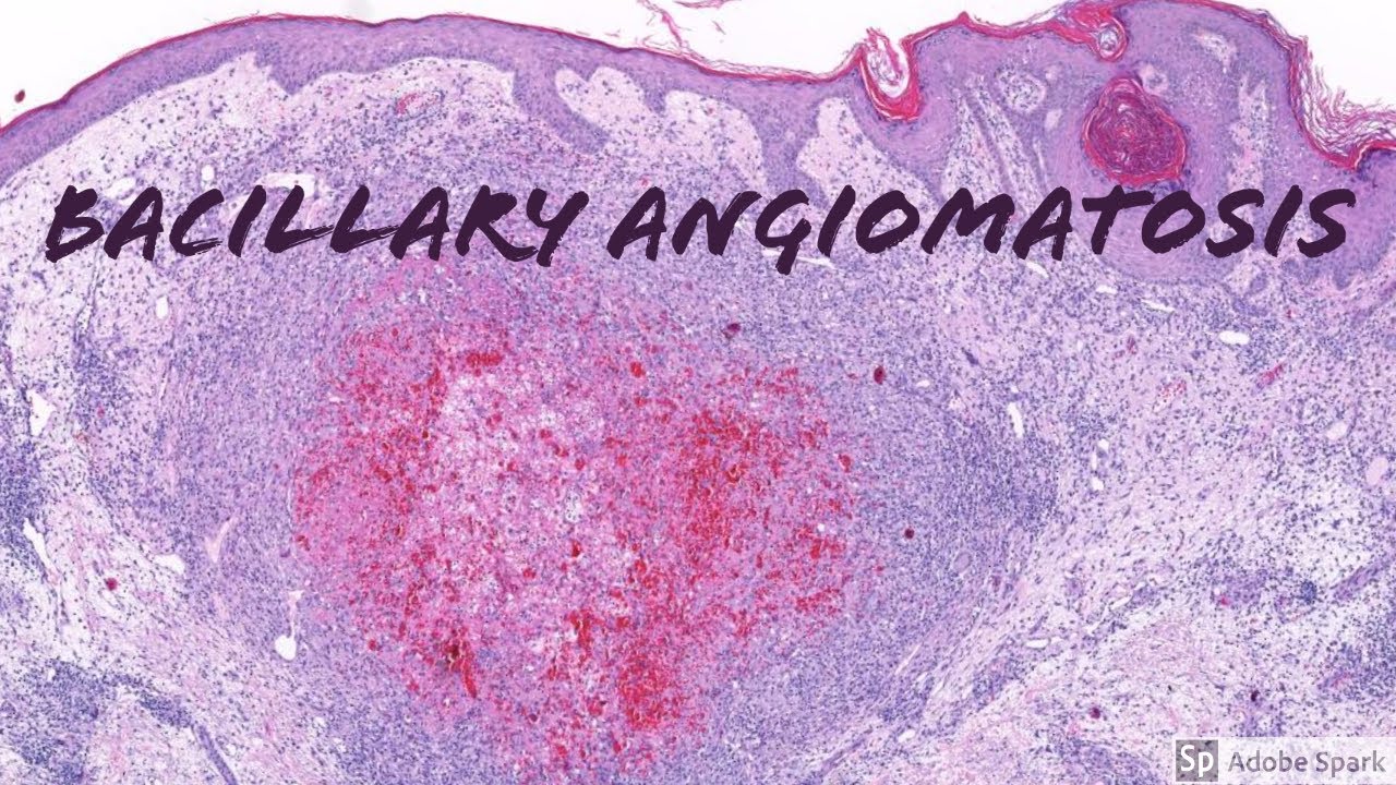 Bacillary Angiomatosis: Dermatopathology Pearls