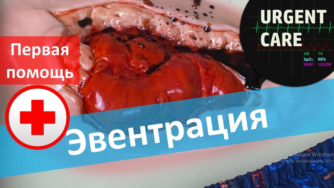 Первая помощь при эвентрации