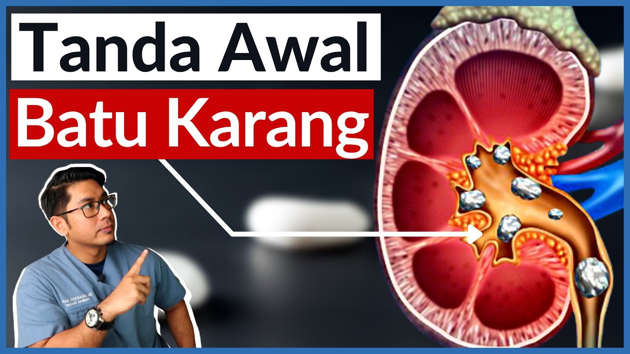 Batu Karang Buah Pinggang | 5 Tanda Awal Wajib Tahu | Doctor Sani |
