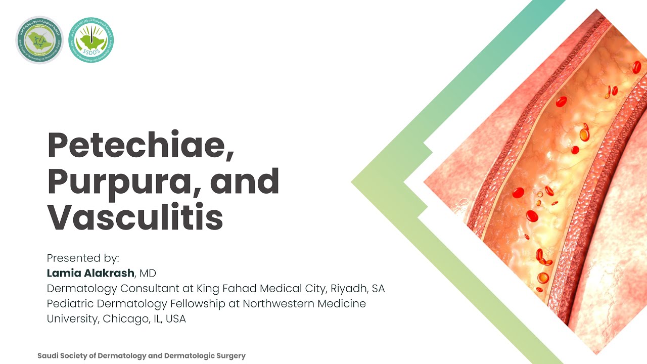 Lecture 18 | Petechiae, Purpura, and Vasculitis | Dr. Lamia Alkaresh
