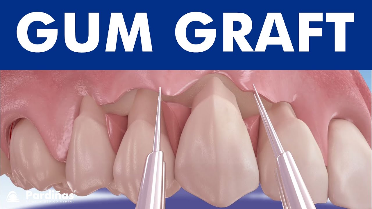Gum graft - Coronally advanced flap - Receding gums treatment ©