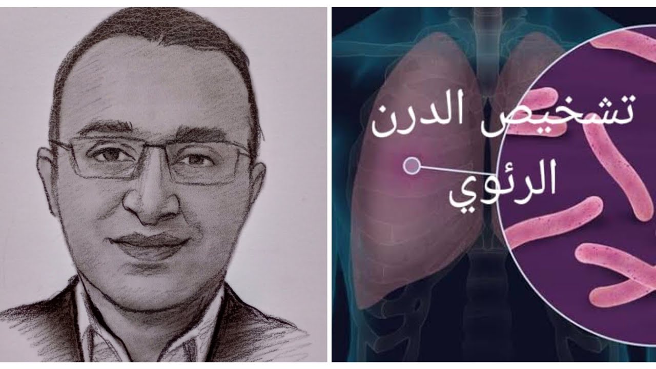 الدرن الرئوي ( السل ) كيف يتم تشخيصه ؟؟ Diagnosis of Tuberculosis