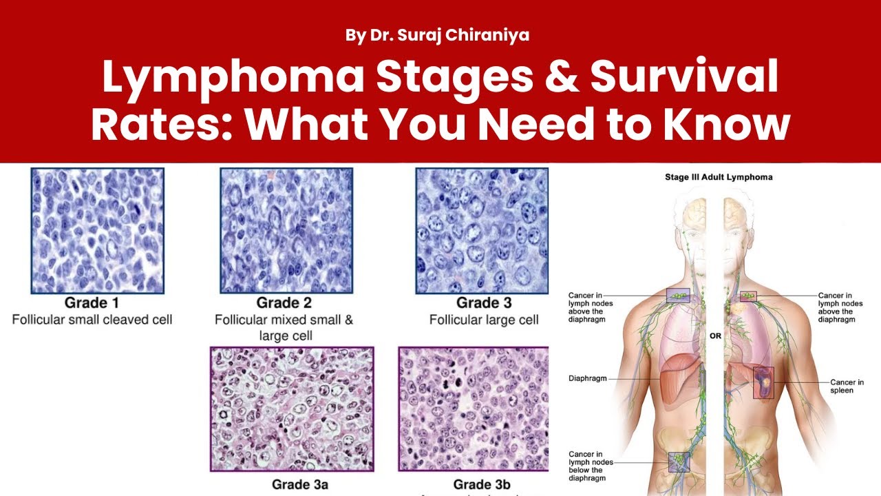 Lymphoma Stages & Survival Rates: What You Need to Know